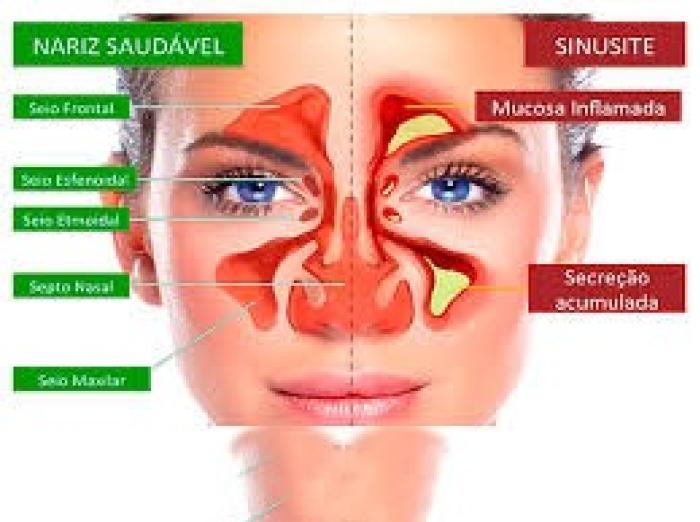 Mudança de temperaturas  ( Sinusites)